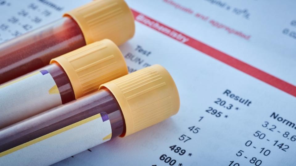 How Long Does Cocaine Stay in Your System blood tests have detection windows for a couple days, narrower than urine.