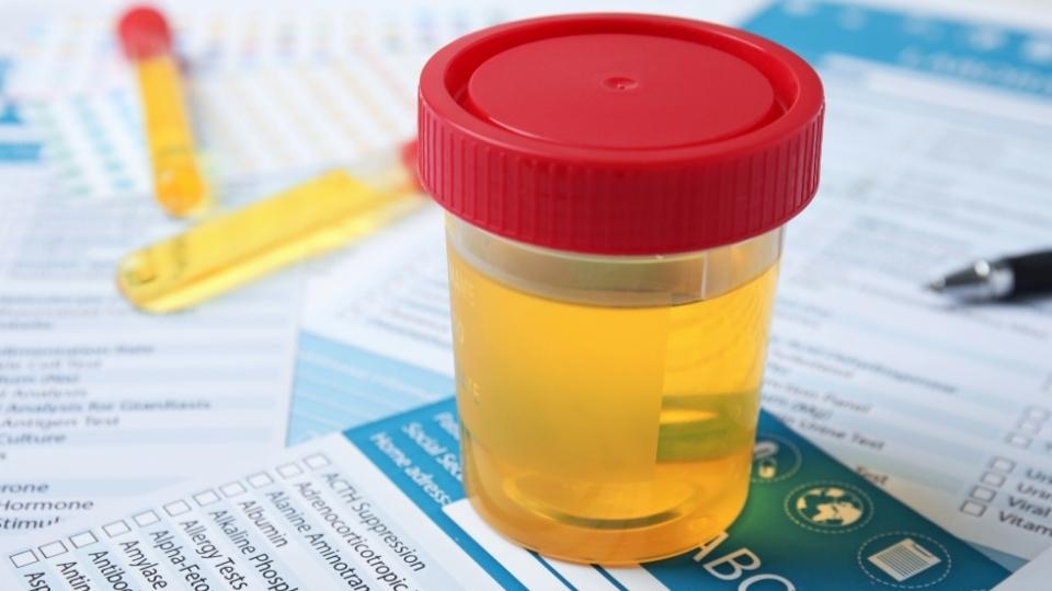 How Long Does Cocaine Stay in Your System typically its detectable in urine for a few days.